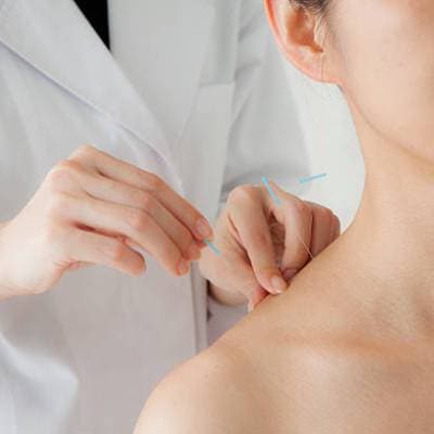 ACUPUNCTURE